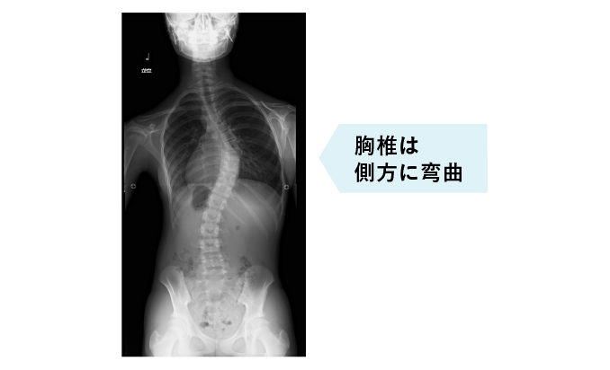 側弯症は どんな病気か 側弯症town 患者向けサイト 日本側彎症学会