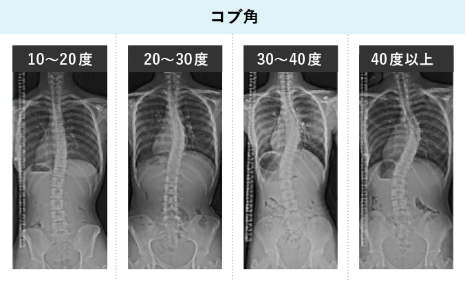 側弯症は どんな病気か 側弯症town 患者向けサイト 日本側彎症学会